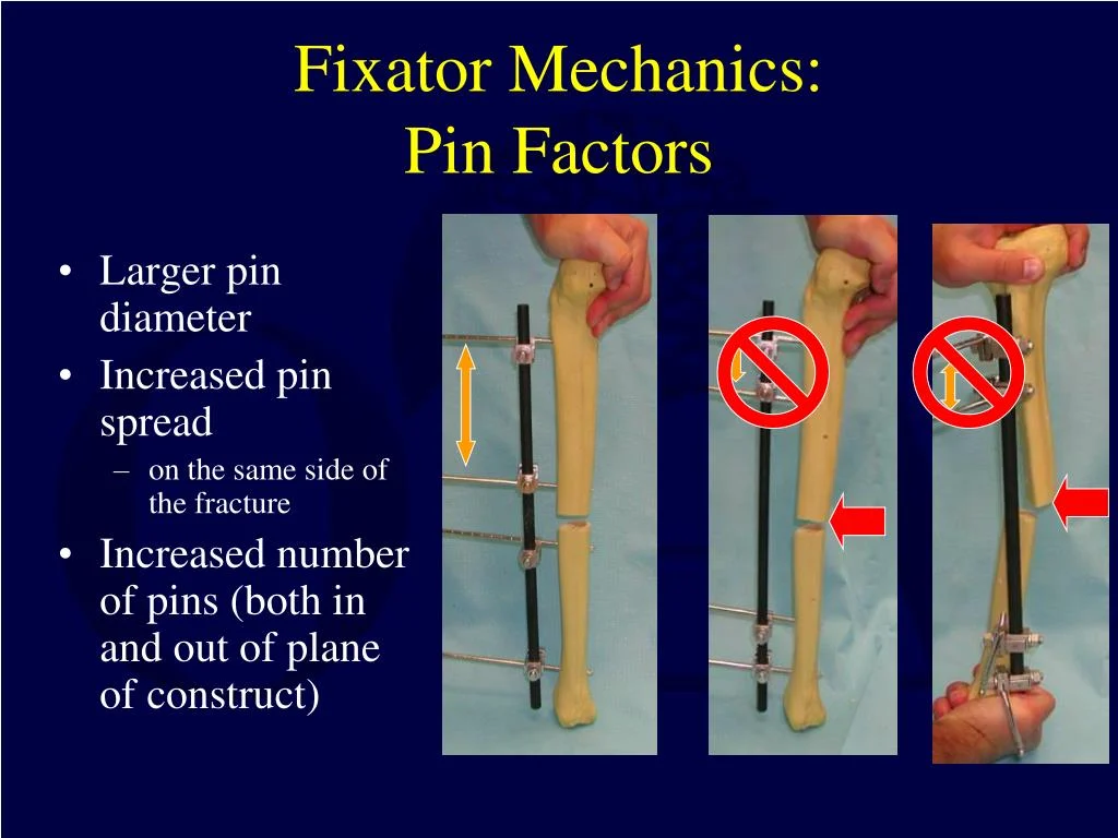 PPT - Principles of External Fixation PowerPoint Presentation, free